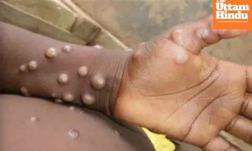 Uganda confirms first mpox death as infections rise to 164
