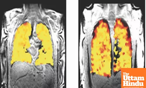 Scientists develop scan that unravels secrets of lung function