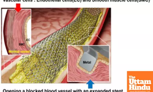 New laser patterning tech to revolutionise stent surgery for heart diseases