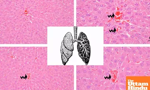 Study says ozone therapy promising new treatment for sepsis-induced lung injury