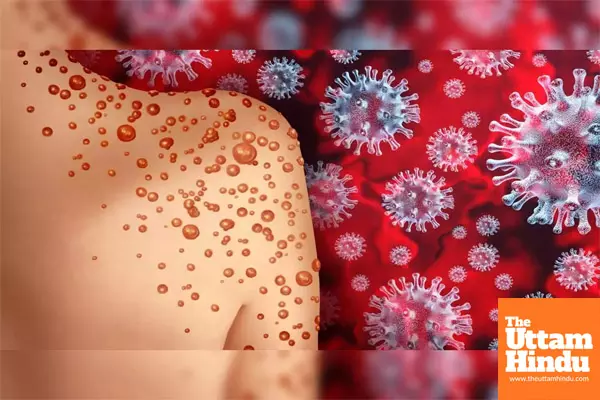 HMPV Virus Reaches Puducherry: 5-Year-Old Girl Tests Positive HMPV Virus Reaches Puducherry: 5-Year-Old Girl Tests Positive