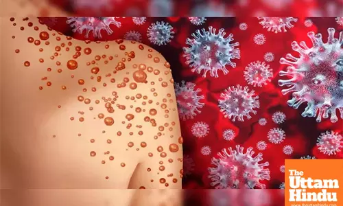 UK reports new Clade Ib mpox case, 4th since January