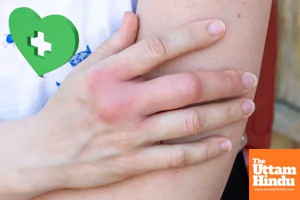 Winter care: Essential tips to soothe swelling and itching in fingers and toes Winter care: Essential tips to soothe swelling and itching in fingers and toes