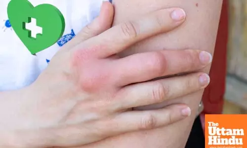 Winter care: Essential tips to soothe swelling and itching in fingers and toes