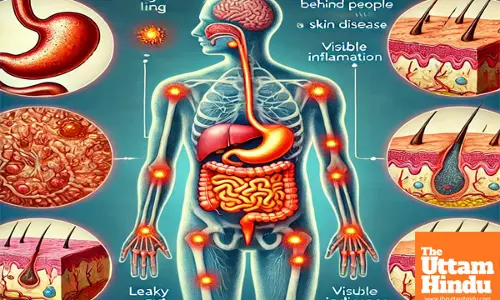 Inflammation behind leaky gut in people with skin disease: Study