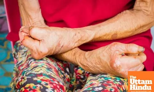 India accounts for 53pc of global leprosy cases, need legal reforms: Experts