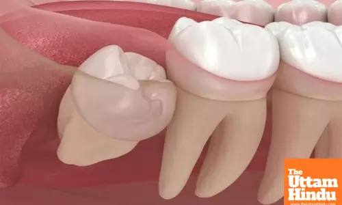 Understanding wisdom tooth extraction and recovery