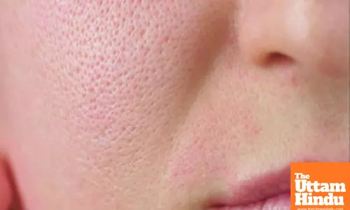 Using this Dal Will Banish Skin Pore Issues – Here’s how and Its Benefits