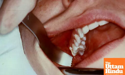 Fix Hollow and Rotten Teeth with Just One Food After Every Meal