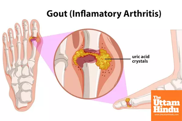 Say goodbye to uric acid problems – Just do this simple thing Say goodbye to uric acid problems – Just do this simple thing