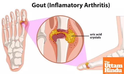 Say goodbye to uric acid problems – Just do this simple thing