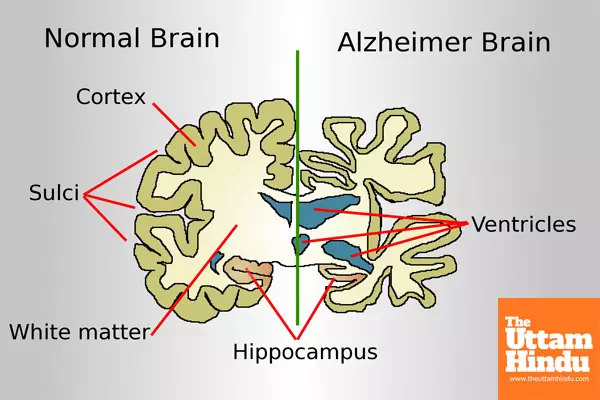 New Blood Test Could Transform Alzheimer’s Diagnosis, Allowing for Earlier Intervention New Blood Test Could Transform Alzheimer’s Diagnosis, Allowing for Earlier Intervention