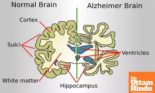 New Blood Test Could Transform Alzheimer’s Diagnosis, Allowing for Earlier Intervention