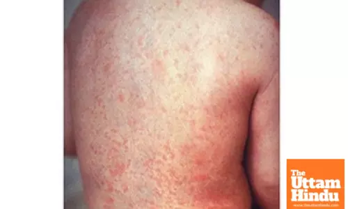 Mongolia confirms imported case of measles