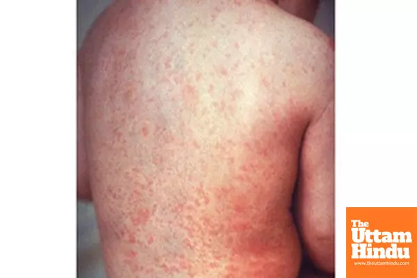 Mongolia confirms imported case of measles Mongolia confirms imported case of measles