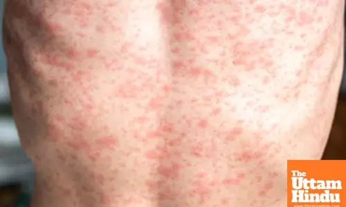 Texas confirms first US death in measles outbreak