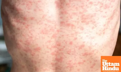 Health alert issued for measles outbreak in Australias Victoria state