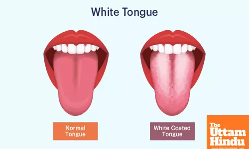 White Coating on Tongue: A Warning Sign of Serious Health Issues