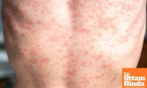 Measles health alert issued for Australian state of Victoria