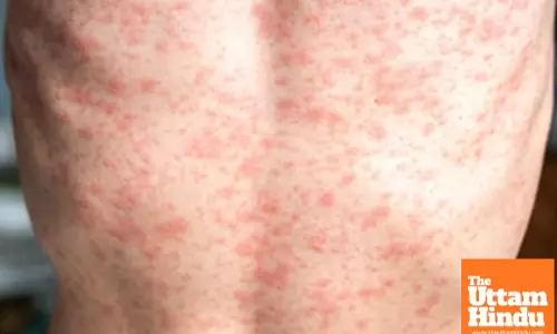 US reports over 300 measles cases in 2025