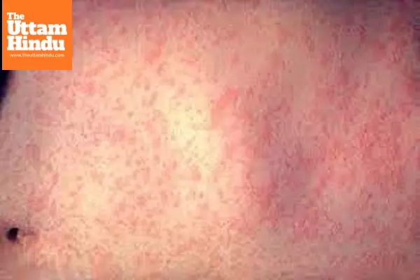 Measles outbreak spreads in US
