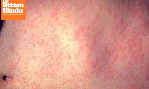 Measles outbreak spreads in US