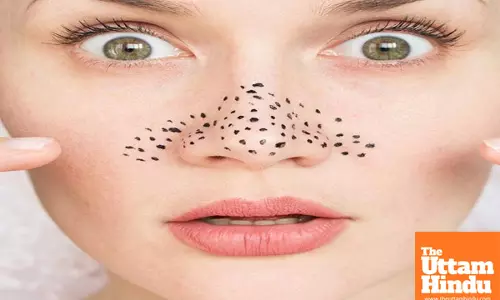 Blackhead Be Gone: 4 Quick DIY Hacks That Actually Work!