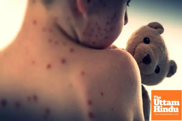 Mongolias measles cases surpass 200