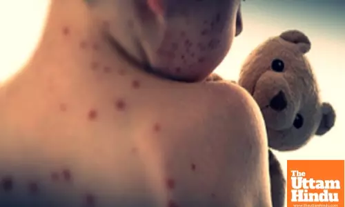 Mongolias measles cases surpass 200