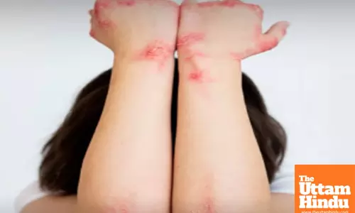 Skin Fungal Infections Are More Likely to Occur During Summer