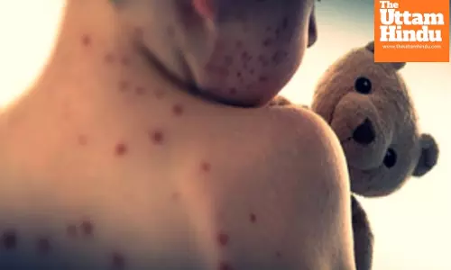 US: Over 560 measles cases confirmed in Texas