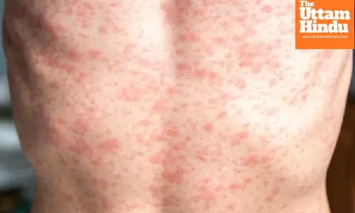 Measles misinformation spreads as cases rise across US