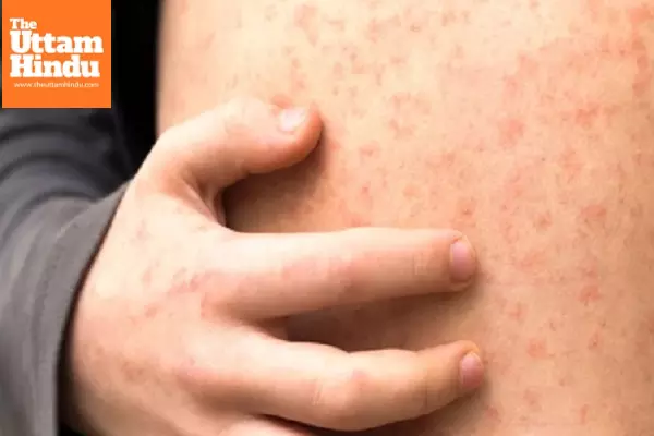 US measles cases continue to rise US measles cases continue to rise