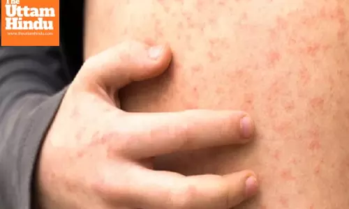 US measles cases continue to rise