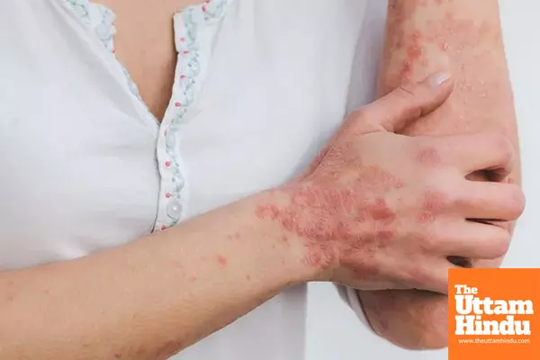 Study shows why psoriasis patients may be at risk of obesity, fatty liver disease Study shows why psoriasis patients may be at risk of obesity, fatty liver disease