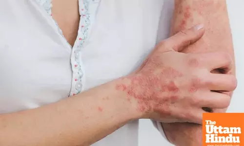 Study shows why psoriasis patients may be at risk of obesity, fatty liver disease