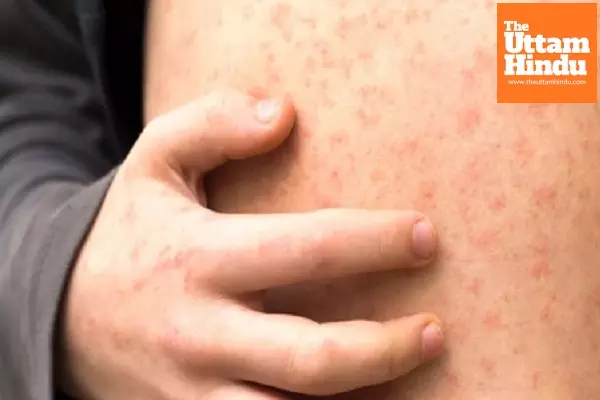 Second child dies of measles in Mongolias capital Second child dies of measles in Mongolias capital