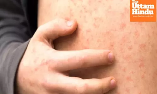 Second child dies of measles in Mongolias capital