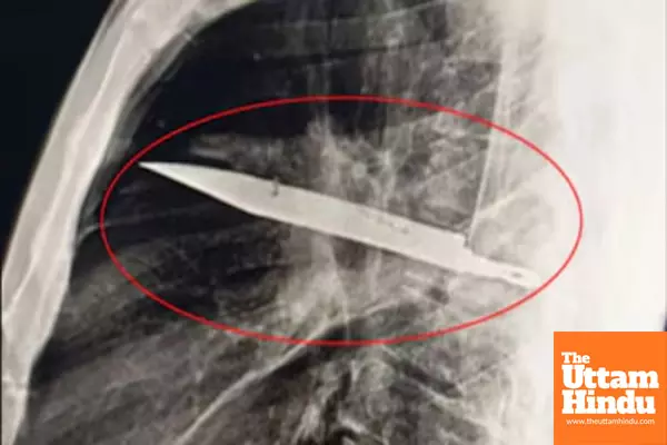 Man Lives with Knife Blade in Chest for 8 Years : A Remarkable Medical Case Man Lives with Knife Blade in Chest for 8 Years : A Remarkable Medical Case