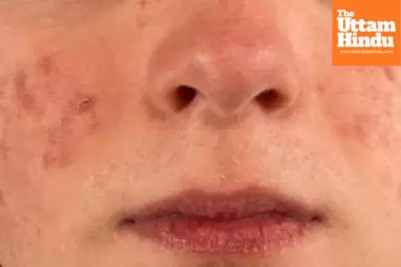 Say goodbye to acne with these three neem face packs—for both oily and dry skin
