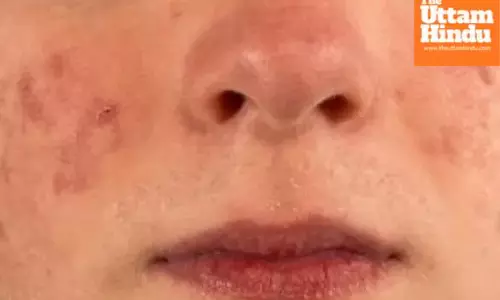 Say goodbye to acne with these three neem face packs—for both oily and dry skin