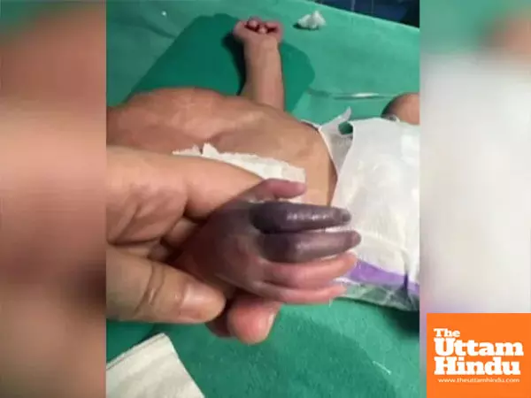 Wrong injection turns devastating: Newborns hand needs amputation due to nursing home negligence Wrong injection turns devastating: Newborns hand needs amputation due to nursing home negligence