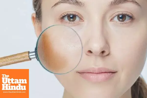 Freckles Signal Vitamin Deficiency in the Body; These Ayurvedic Remedies May Provide Relief Freckles Signal Vitamin Deficiency in the Body; These Ayurvedic Remedies May Provide Relief