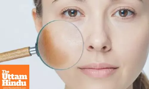 Freckles Signal Vitamin Deficiency in the Body; These Ayurvedic Remedies May Provide Relief